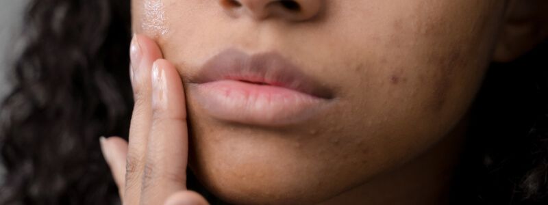 Unreine Haut und Akne - Was hilft wirklich gegen Pickel?