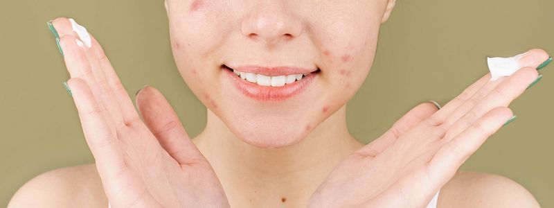 Zinksalbe gegen Pickel und Mitesser – Pflege für unreine Haut